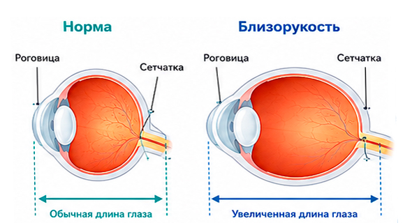 глаз при миопии